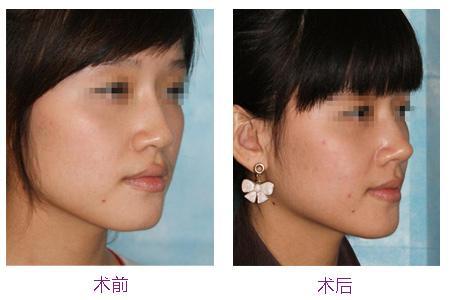 隆鼻后修復(fù)手術(shù)恢復(fù)時(shí)間會(huì)更長(zhǎng)嗎？