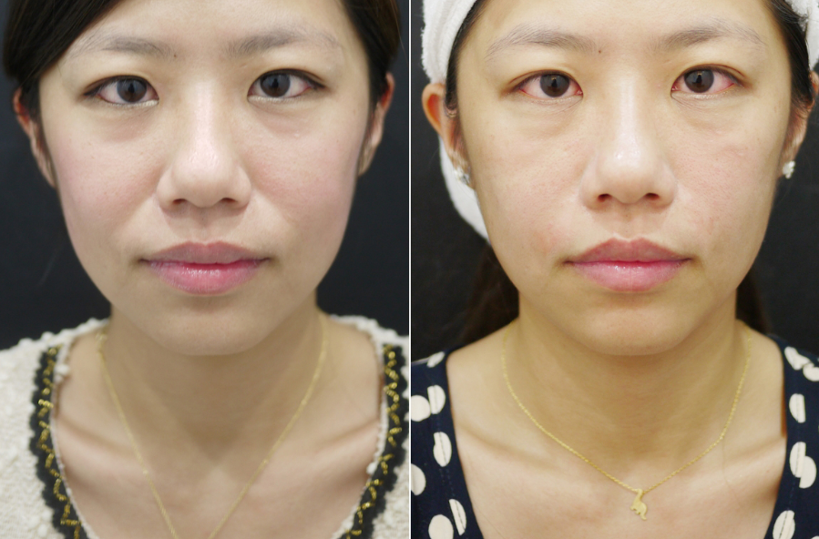 去法令紋有什么好辦法？