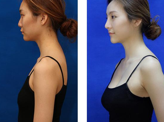 上海豐胸需要多少錢？