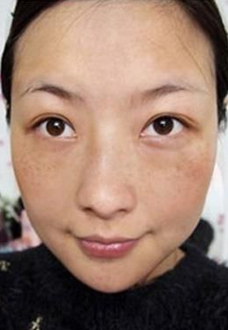 激光祛斑疼嗎？