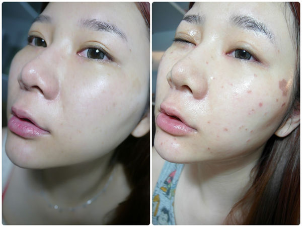 激光祛斑痛不痛？