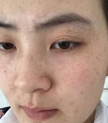 臉上長斑的原因是什么？