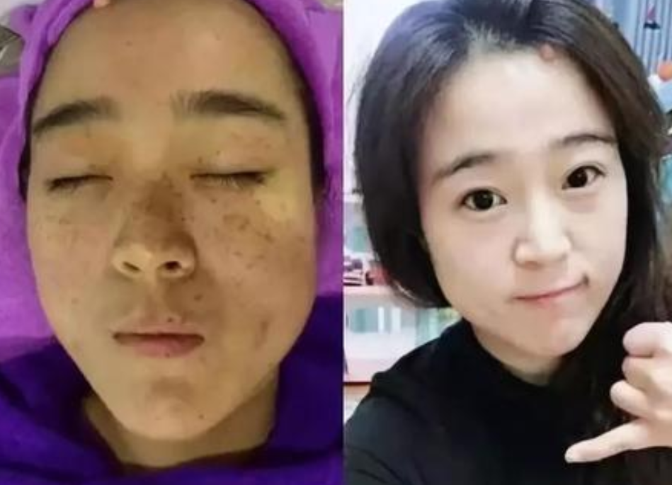 快速祛斑的方法有哪些？