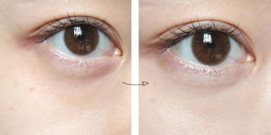 祛眼袋手術(shù)多少錢？