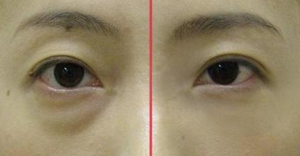 祛眼袋手術(shù)多少錢？