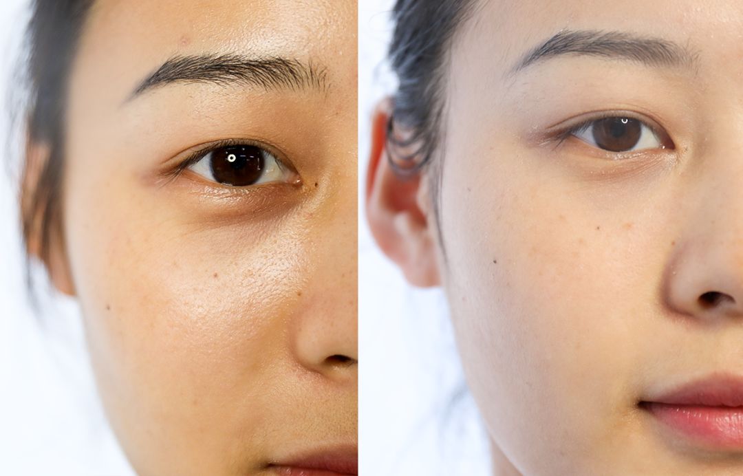 選擇激光去掉黑眼圈有什么注意事項(xiàng)？