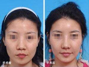 鼻翼太大，該怎么縮小鼻翼？