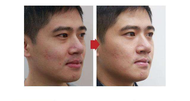 鼻子大怎么辦？能做手術(shù)縮小嗎？