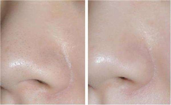 鼻子上有黑頭怎么辦？