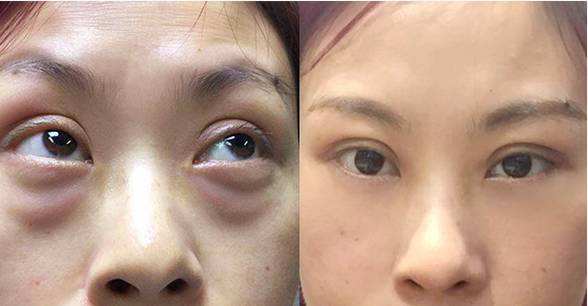 怎么消除眼袋這個煩人精？