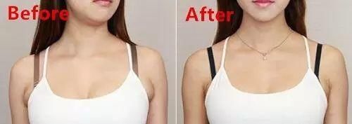 副乳怎么消除？