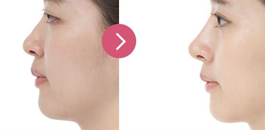 隆鼻整形手術(shù)效果好嗎？