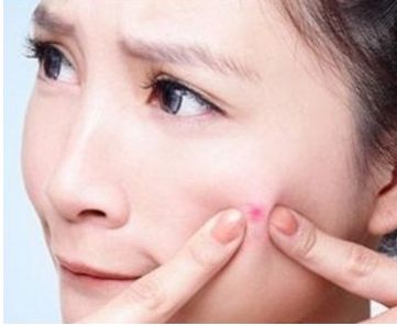 滿臉痘印怎么辦？