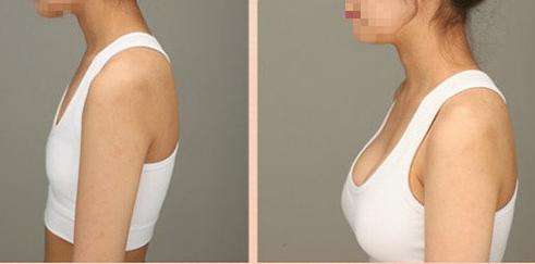 豐胸手術一般多少錢？