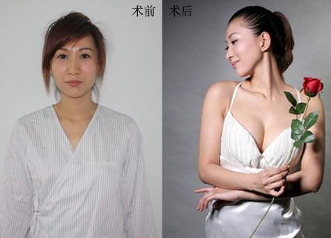 豐胸醫(yī)院怎么選？