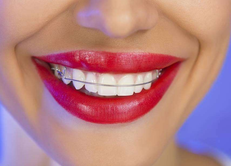 門牙矯正怎么樣？