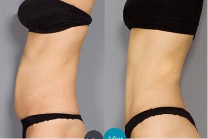 腹部吸脂手術(shù)安全嗎？