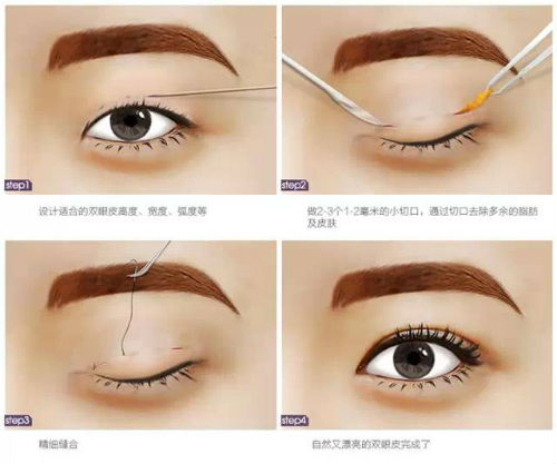 埋線(xiàn)雙眼皮