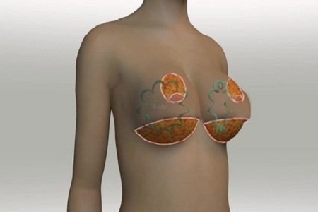 重慶做假體豐胸手術(shù)多少錢(qián)