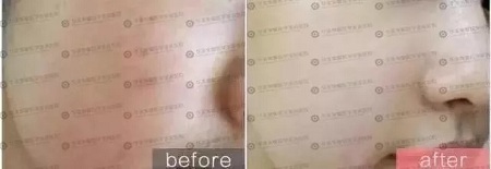 水光后為什么皮膚反而會變黑？