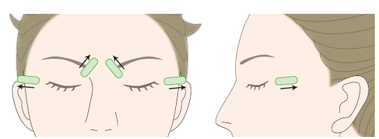 眼睛周?chē)邪毯勰茏雎窬€(xiàn)雙眼皮嗎