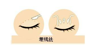 埋線(xiàn)雙眼皮