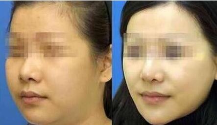 臉部抽脂效果好嗎？