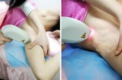 激光脫毛術(shù)后怎么護(hù)理？