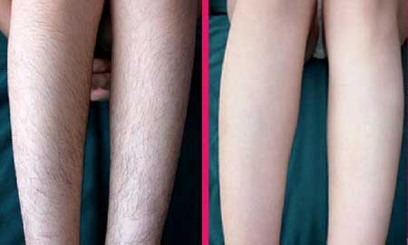 小腿激光脫毛后怎么護(hù)理？