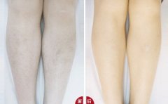 性脫毛對(duì)身體健康有危害嗎？