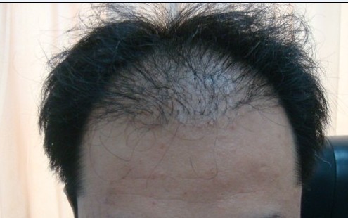 植發(fā)多少錢？