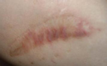 燒傷疤痕修復(fù)要注意什么？