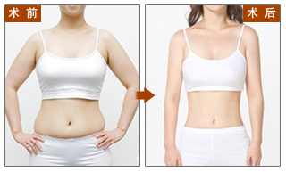 深圳360吸脂減肥一般多少錢？