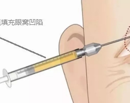 新年集福，怎可讓“眼窩凹陷”影響運(yùn)氣？