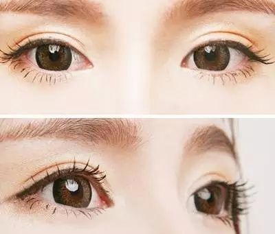 埋線雙眼皮術后怎么護理？