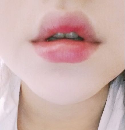 玻尿酸豐唇的效果怎么樣？