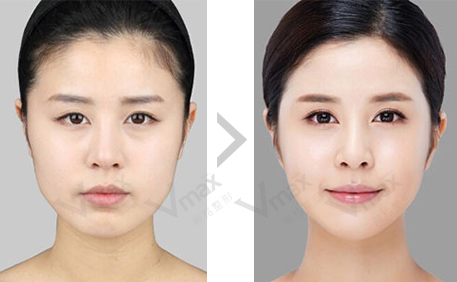 昆明開眼角要多久恢復(fù)？有什么注意事項(xiàng)？