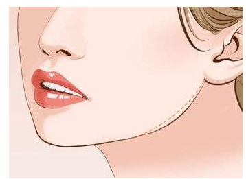 成都下頜角整形手術(shù)需要多少錢？