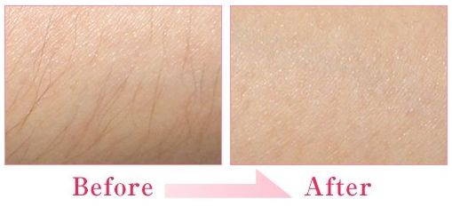 美萊冰點(diǎn)脫毛效果怎么樣？