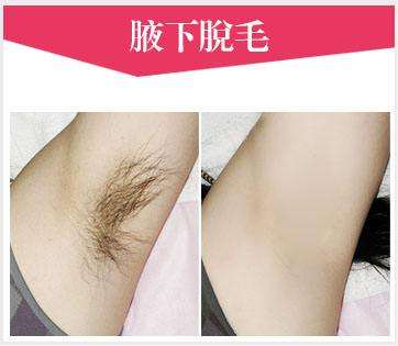 冰點激光脫毛效果好嗎？