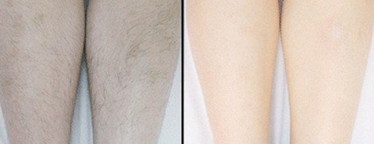 腿部脫毛用什么辦法效果比較好呢?