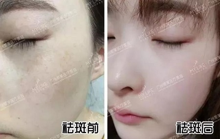 1次祛斑，就有無暇、透亮的大白皮？