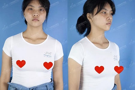 what？34C罩杯的細腿精，抽了200ml脂肪隆胸！