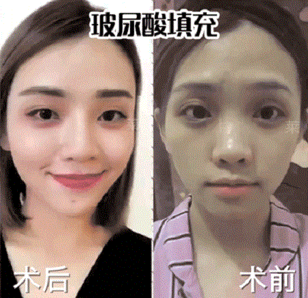 面對(duì)法令紋，玻尿酸or脂肪填充誰(shuí)才是救命大佬？