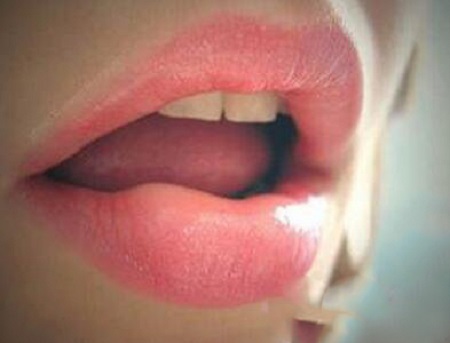 膨體墊下巴效果到底怎么樣？