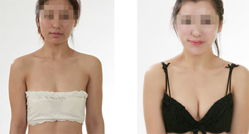 做假體隆胸要定期更換假體嗎？