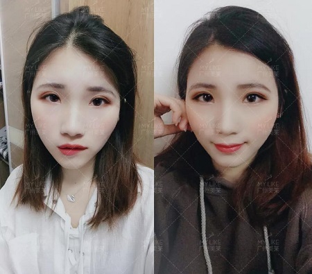 <a href='/ybzx/syp/' target='_blank'><u>割雙眼皮</u></a>5天，土妞變潮妹！