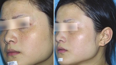 光子嫩膚祛斑手術(shù)一般需要多少錢(qián)?