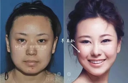 這四種臉型打玻尿酸+瘦臉，立刻變專業(yè)小V臉