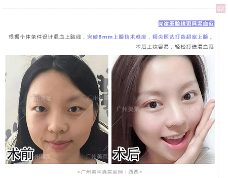 腫眼泡？重內(nèi)眥？